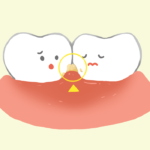 歯肉炎と歯垢