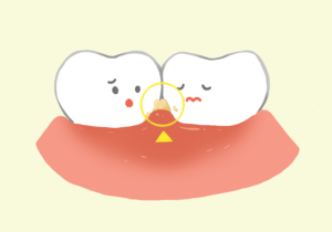 歯肉炎と歯垢