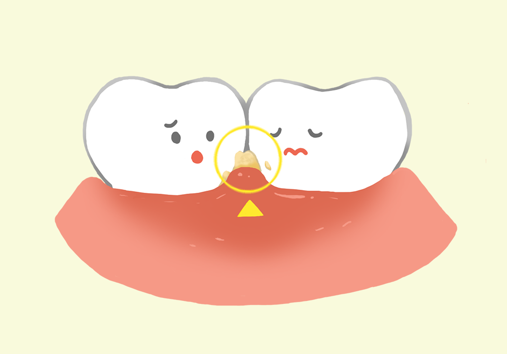 歯肉炎と歯垢